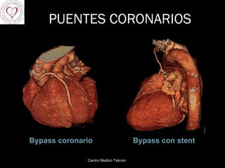 PUENTES CORONARIOS Bypass coronario Bypass con stent Centro Medico Teknon 