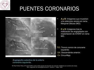PUENTES CORONARIOS Angiografía selectiva de la arteria coronaria izquierda. A y B:  Imágenes que muestran una estenosis severa en rama Marginal Obtusa (MO).  C y D:  Imágenes tras la realización de angioplastia con implantación de STENT en rama MO.  TCI:  Tronco común de coronaria izquierda.  DA:  Descendente anterior. Cx:  Circunfleja. Mª Pilar Portero Pérez; Mª Jesús Pinilla Lozano Infarto agudo de miocardio tras reacción anafiláctica por picadura de avispa, Rev. Aragonesa de CardiologiaVolumen 9 - Número 1 - Mayo  2006 