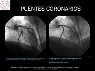 PUENTES CORONARIOS Cinecoronariografía que muestra importante carga trombótica en el sitio de la lesión de la arteria descendente anterior. Angiografía coronaria luego de la colocación del stent . MARIANO C. RUBIO*, CLAUDIO SUELDO PEREYRA†, CARLOS R. RUBIO Revista de la Federación Argentina de Cardiología Volumen 37 - Nº 4 Octubre - Diciembre 2008 