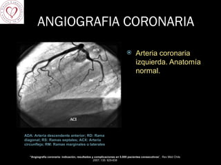 ANGIOGRAFIA CORONARIA ADA: Arteria descendente anterior; RD: Rama diagonal; RS: Ramas septales; ACX: Arteria circunfleja; RM: Ramas marginales o laterales Arteria coronaria izquierda. Anatomía normal.  “ Angiografía coronaria: indicación, resultados y complicaciones en 5.000 pacientes consecutivos ”,  Rev Méd Chile 2007; 135: 829-838 