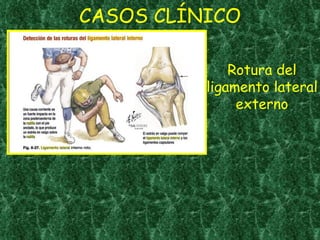 CASOS CLÍNICO Rotura del ligamento lateral externo 