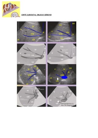 CORTE SUBCOSTAL OBLICUO DERECHO




                                                                                     III
                                                             IVb
                      IV

     V
                                               V
                                     II                                  IVa
                    VIII                                     VIII                    II
                                          VI
                                                              VII
VI                    VII




                          III
                                II                                             III
               IV                                  V                IV

                                                                          II

     V         VIII                                           VIII
                                           VI
                    VII
                                                       VII

              VI
 