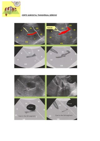 CORTE SUBCOSTAL TRANSVERSAL DERECHO




                                                       III
                                      Vesícula
                  IV       III                    IV
     V                                                       II
                                           V

                                 II

VI                                       VI             I
                       I
            VII
                                                 VII
 