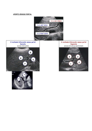 APORTE VENOSO PORTAL



                                                           Porta ASC IZQDA


                                         Porta ANT DCHA




                                         Porta POST DCHA




H reclinada bifurcación venosa portal                                    H reclinada bifurcación venosa portal
              Derecha                                                                  Izquierda
          (acceso intercostal)                                               (proyección oblicua subxifoideal)




                                 5

                                                                                     4             3
                8
                                     6
                                                                                                       2
                      7                                                                  1




                      5


            8
 
