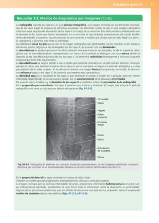 Anatomía general 71
La radiografía consiste en capturar, en una película fotográfica, una imagen formada por las diferentes intensida-
des de los rayos luego de atravesar la estructura estudiada. Los diferentes niveles de gris en una imagen radiográfica
informan sobre el grado de atenuación de los rayos X a lo largo de su recorrido. Esta atenuación está relacionada con
la densidad de los tejidos que fueron atravesados. En su recorrido, el rayo atraviesa sucesivamente estructuras de dife-
rentes densidades y espesores; las atenuaciones se van sumando a medida que el rayo avanza hasta llegar a la pelícu-
la radiográfica o al sensor que mide su intensidad.
Los diferentes tonos de gris que se ven en la imagen radiográfica son identificados con los nombres de los tejidos o
elementos que los originan al ser atravesados por los rayos X, de acuerdo con sus densidades:
La densidad aire se produce porque el haz de la radiación atraviesa el aire sin ser atenuado, incide en la película radio-
gráfica con la intensidad original, impregnándola con fuerza. En la película se distingue una zona oscura debido al
depósito de las sales de plata producido por los rayos X. Se denomina radiolúcida (transparente a los rayos X) aquella
sustancia que tiene esta característica.
La densidad hueso se origina debido a que el tejido óseo presenta minerales con un alto número atómico, como por
ejemplo el calcio, que detienen el avance de los rayos X, por lo cual éstos no llegan a la película radiográfica y no hay
precipitación de las sales de plata. En la película se observa una imagen blanca (transparente, iluminada). Se denomi-
na radiopaca (opaca a los rayos X) la sustancia que presenta esta característica.
La densidad agua es el resultado de los rayos X que atraviesan el cuerpo e inciden en la película, pero con menor
intensidad, dependiendo de su atenuación parcial. Así, el oscurecimiento de la película es intermedio.
De acuerdo con la incidencia y la dirección de los rayos X se establece el tipo de proyección de la radiografía:
En la proyección posteroanterior, los rayos X penetran por el dorso y atraviesan el cuerpo para alcanzar la película
radiográfica o el detector ubicado por delante del paciente (fig. R1-2-1).
En la proyección lateral los rayos atraviesan el cuerpo de lado a lado.
También se pueden realizar proyecciones anteroposteriores, oblicuas y verticales (axiales).
La imagen, formada por las distintas intensidades de grises, proporciona información bidimensional acerca del cuer-
po tridimensional estudiado, perdiéndose de esta forma toda la información sobre la disposición en profundidad.
Algunas de las estructuras anatómicas que son difíciles de discriminar con esta técnica, se pueden destacar empleando
medios de contraste (véase más adelante [figs. R1-2-2 y R1-2-3]).
Recuadro 1-2. Medios de diagnóstico por imágenes (Cont.)
11a
costilla
Colon
Hígado
Riñón
izquierdo
M. psoas
mayor
Coxal
Sacro
Articulación
de la cadera
Fémur
Fig. R1-2-1. Radiografía de abdomen sin contraste. Proyección posteroanterior. Se ven imágenes radiolúcidas correspon-
dientes al gas intestinal. Se ve la radioopacidad hepática en la parte superior del hemiabdomen derecho.
b027-01.qxd 7/14/11 12:50 PM Page 71
ERRNVPHGLFRVRUJ
 