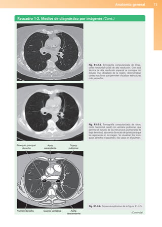 Anatomía general 73
Recuadro 1-2. Medios de diagnóstico por imágenes (Cont.)
(Continúa)
Bronquio principal
derecho
Pulmón derecho Cuerpo vertebral Aorta
descendente
Aorta
ascendente
Tronco
pulmonar
Fig. R1-2-4. Tomografía computarizada de tórax,
corte horizontal (axial) de alta resolución. Con esta
técnica de alta resolución espacial se consigue un
estudio más detallado de la región, obteniéndose
cortes más finos que permiten visualizar estructuras
más pequeñas.
Fig. R1-2-5. Tomografía computarizada de tórax,
corte horizontal (axial) con ventana pulmonar, que
permite el estudio de las estructuras pulmonares de
baja densidad, ajustando la escala de grises para que
las represente en la imagen. Se visualizan los bron-
quios derecho e izquierdo y los vasos en el pulmón.
Fig. R1-2-6. Esquema explicativo de la figura R1-2-5.
b027-01.qxd 7/14/11 12:50 PM Page 73
ERRNVPHGLFRVRUJ
 