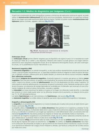 Anatomía clínica
74
Recuadro 1-2. Medios de diagnóstico por imágenes (Cont.)
A partir de la combinación de cortes tomográficos sucesivos o de técnicas de exploración continua en espiral, se puede
realizar la reconstrucción tridimensional (3D) de las estructuras estudiadas, representando sus superficies sombrea-
das en una imagen que puede examinarse desde distintos ángulos. También se pueden realizar reconstrucciones mul-
tiplanares (planos coronales, sagitales y oblicuos) (fig. R1-2-7).
Endoscopia virtual
La endoscopia virtual permite obtener imágenes para el diagnóstico de órganos huecos sin la necesidad de invadir
el cuerpo por medio de un catéter u otro dispositivo. Mediante este sistema se puede generar una imagen tridimen-
sional de los vasos sanguíneos (angiografía virtual), de la vía respiratoria (broncografía virtual) y del colon (colonogra-
fía virtual), con la posibilidad de recorrer internamente su luz.
Resonancia magnética (RM)
La resonancia magnética es un método tomográfico, es decir que produce representaciones visuales de secciones del
cuerpo, cuyas principales características son: su capacidad multiplanar (produce imágenes en todos los planos del espa-
cio), su elevado contraste y diferenciación de los tejidos blandos y la ausencia de efectos nocivos conocidos al no uti-
lizar radiaciones ionizantes.
Para obtener imágenes de resonancia magnética, el paciente ingresa en un escáner que genera un intenso campo
magnético. Éste sirve para orientar, en paralelo al eje longitudinal, los protones de los átomos de hidrógeno del orga-
nismo. Luego se los somete a ondas de radiofrecuencia, con el fin de desalinearlos de dicho campo magnético. Al
interrumpirse la señal de radiofrecuencia, los protones recuperan la orientación inicial, liberando energía que es medi-
da por el escáner. Las variaciones de energía registradas son analizadas por el ordenador, que construye con esta infor-
mación imágenes de cortes en planos horizontales, coronales y sagitales.
La intensidad con la que reaccionan los tejidos se muestra en la imagen con diferentes niveles de brillo. La intensidad
que presenta un mismo tejido puede variar con los diferentes tiempos entre la excitación y la relajación de los proto-
nes: T1, T2, DP (densidad protónica).
Los tejidos hiperintensos se ven más luminosos y los hipointensos, más oscuros (fig. R1-2-8).
La resonancia magnética no se debe realizar en pacientes que porten alguna prótesis ferromagnética o marcapasos.
Ecografía o ultrasonografía (US)
La ecografía es un procedimiento diagnóstico no invasivo empleado para visualizar estructuras de tejido blando super-
ficiales y profundas (fig. R1-2-9).
La ecografía utiliza un transductor que emite ondas ultrasónicas. Éstas penetran en el organismo y atraviesan los teji-
dos. A medida que progresa, el ultrasonido rebota (eco) o pasa a través de las estructuras orgánicas. El transductor recoge
el eco y un ordenador lo convierte en una imagen que representa un corte bidimensional o bien una reconstrucción tridi-
mensional (cuadro R1-2-1). Esta técnica produce las imágenes en tiempo real, permitiendo mostrar el movimiento.
La obtención de imágenes ecográficas es un procedimiento simple, que al no utilizar radiaciones ionizantes resulta de
gran utilidad para la visualización fetal en el útero de la madre (fig. R1-2-10).
El hueso compacto refleja prácticamente todas las ondas ultrasónicas y el aire las conduce mal, dificultando el estu-
dio de algunas regiones del cuerpo con esta técnica. Los líquidos, en cambio, son buenos conductores. Para mejo-
rar la conducción del ultrasonido se emplea un gel que elimina el aire existente entre el transductor y la piel. En la pel-
vis se aprovecha la distensión de la vejiga urinaria mediante su llenado, que facilita la conducción de la ondas sonoras
por medio de la orina.
Tráquea
Bronquio
principal
izquierdo
Bronquio
principal
derecho
Pulmón
derecho Pulmón
izquierdo
Fig. R1-2-7. Reconstrucción tridimensional de tomografía
computarizada del árbol bronquial.
(Continúa)
b027-01.qxd 7/14/11 12:50 PM Page 74
ERRNVPHGLFRVRUJ
 