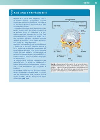 Caso clínico 2-1: hernia de disco
El señor H. D., de 56 años, empleado, consul-
ta al médico debido a que presenta un dolor
intenso en la región dorsolumbar, vinculado a
un esfuerzo que realizó al transportar un tele-
visor de gran tamaño.
Al examen físico el paciente presenta dolor en
la cara posterolateral del muslo izquierdo que
se extiende hacia la pantorrilla y el pie.
Presenta también impotencia funcional para
extender el muslo, ausencia del reflejo calcá-
neo (aquiliano) izquierdo y aumento de dolor
al elevar el miembro con la rodilla en exten-
sión (signo de Lasègue positivo).
El médico solicita radiografías anteroposterior
y lateral de la columna vertebral lumbar y
sacra, en las que se observa la disminución del
espacio entre el cuerpo de la quinta vértebra
lumbar y la base del sacro. En una imagen de
resonancia magnética de la columna lumbosa-
cra se observa la protrusión del núcleo pulpo-
so del disco L5-S1.
Se diagnostica un síndrome lumbociático por
hernia de disco y se le indica al paciente trata-
miento médico con antiinflamatorios, fisiotera-
pia y corsé emballenado para contener la
columna.
La hernia del núcleo pulposo de un disco inter-
vertebral produce inflamación local y compre-
sión del nervio espinal o de sus raíces, lo que
origina el dolor y afecta a la función del nervio
involucrado (fig. 2-1).
Disco intervertebral
Anillo fibroso,
parte externa
Ramo anterior
del n. espinal
Cola
de caballo
Ganglio sensitivo
del n. espinal
Espacio
epidural
Ramo
meníngeo
Anillo fibroso,
parte interna
Hernia
del núcleo
pulposo
Núcleo pulposo
Fig. 2-1. Esquema de la formación de la hernia de disco.
Corte horizontal de un disco intervertebral lumbar, vista
superior. Del lado izquierdo se representa una fisura del ani-
llo fibroso. Del lado derecho se ve la protrusión del núcleo
pulposo que comprime las raíces del nervio espinal.
Dorso 83
b027-02.qxd 7/12/11 8:38 AM Page 83
ERRNVPHGLFRVRUJ
 