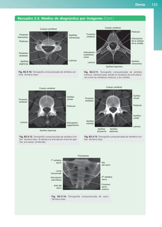 Dorso 133
Recuadro 2-3. Medios de diagnóstico por imágenes (Cont.)
Foramen
vertebral
Articulación
costotrans-
versa
Articulación
de la cabeza
de la costilla
Pedículo
Cuerpo vertebral
Apófisis espinosa
Lámina
Apófisis
transversa
Fig. R2-3-11. Tomografía computarizada de vértebra
torácica. Ventana ósea, donde se visualizan las articulacio-
nes entre las vértebras torácicas y las costillas.
Cuerpo vertebral
Epífisis
anular
Pedículo
Articulación
cigapofisaria
Apófisis espinosa
Foramen
vertebral
Lámina
Fig. R2-3-12. Tomografía computarizada de vértebra lum-
bar. Ventana ósea. Se destaca la articulación entre las apó-
fisis articulares vertebrales.
Cuerpo vertebral
Epífisis
anular
Pedículo
Apófisis
costal
Lámina
Apófisis
espinosa
Apófisis
accesoria
Apófisis
mamilar
Foramen
vertebral
Fig. R2-3-13. Tomografía computarizada de vértebra lum-
bar. Ventana ósea.
Pedículo
Foramen
transverso
Foramen
vertebral
Apófisis
espinosa
Lámina
Apófisis
transversa
Cuerpo vertebral
Fig. R2-3-10. Tomografía computarizada de vértebra cer-
vical. Ventana ósea.
Fig. R2-3-14. Tomografía computarizada de sacro.
Ventana ósea.
Promontorio
Ala
del sacro
3a
vértebra
sacra
Foramen
sacro
anterior
Asta del
sacro
1a vértebra
sacra
Línea
transversal
Articulación
sacroilíaca
b027-02.qxd 7/12/11 8:39 AM Page 133
ERRNVPHGLFRVRUJ
 