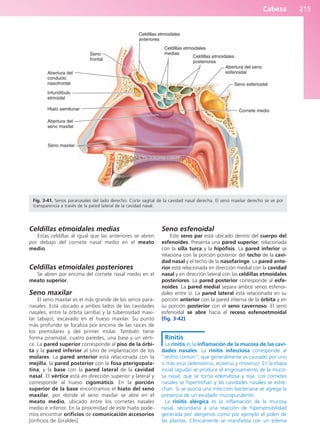 Cabeza 215
Celdillas etmoidales medias
Estas celdillas al igual que las anteriores se abren
por debajo del cornete nasal medio en el meato
medio.
Celdillas etmoidales posteriores
Se abren por encima del cornete nasal medio en el
meato superior.
Seno maxilar
El seno maxilar es el más grande de los senos para-
nasales. Está ubicado a ambos lados de las cavidades
nasales, entre la órbita (arriba) y la tuberosidad maxi-
lar (abajo), excavado en el hueso maxilar. Su punto
más profundo se localiza por encima de las raíces de
los premolares y del primer molar. También tiene
forma piramidal, cuatro paredes, una base y un vérti-
ce. La pared superior corresponde al piso de la órbi-
ta y la pared inferior al sitio de implantación de los
molares. La pared anterior está relacionada con la
mejilla, la pared posterior con la fosa pterigopala-
tina, y la base con la pared lateral de la cavidad
nasal. El vértice está en dirección superior y lateral y
corresponde al hueso cigomático. En la porción
superior de la base encontramos el hiato del seno
maxilar, por donde el seno maxilar se abre en el
meato medio, ubicado entre los cornetes nasales
medio e inferior. En la proximidad de este hiato pode-
mos encontrar orificios de comunicación accesorios
[orificios de Giraldes].
Seno esfenoidal
Este seno par está ubicado dentro del cuerpo del
esfenoides. Presenta una pared superior, relacionada
con la silla turca y la hipófisis. La pared inferior se
relaciona con la porción posterior del techo de la cavi-
dad nasal y el techo de la nasofaringe. La pared ante-
rior está relacionada en dirección medial con la cavidad
nasal y en dirección lateral con las celdillas etmoidales
posteriores. La pared posterior corresponde al esfe-
noides. La pared medial separa ambos senos esfenoi-
dales entre sí. La pared lateral está relacionada en su
porción anterior con la pared interna de la órbita y en
su porción posterior con el seno cavernoso. El seno
esfenoidal se abre hacia el receso esfenoetmoidal
(fig. 3-42).
Rinitis
La rinitis es la inflamación de la mucosa de las cavi-
dades nasales. La rinitis infecciosa corresponde al
“resfrío común”, que generalmente es causado por uno
o más virus (adenovirus, ecovirus y rinovirus). En la etapa
incial (aguda) se produce el engrosamiento de la muco-
sa nasal, que se torna edematosa y roja. Los cornetes
nasales se hipertrofian y las cavidades nasales se estre-
chan. Si se asocia una infección bacteriana se agrega la
presencia de un exudado mucopurulento.
La rinitis alérgica es la inflamación de la mucosa
nasal, secundaria a una reacción de hipersensibilidad
generada por alergenos como por ejemplo el polen de
las plantas. Clínicamente se manifiesta con un edema
Seno
frontal
Abertura del
conducto
nasofrontal
Infundíbulo
etmoidal
Hiato semilunar
Abertura del
seno maxilar
Seno maxilar
Cornete medio
Seno esfenoidal
Abertura del seno
esfenoidal
Celdillas etmoidales
posteriores
Celdillas etmoidales
medias
Celdillas etmoidales
anteriores
Fig. 3-41. Senos paranasales del lado derecho. Corte sagital de la cavidad nasal derecha. El seno maxilar derecho se ve por
transparencia a través de la pared lateral de la cavidad nasal.
b027-03.qxd 7/12/11 2:37 PM Page 215
ERRNVPHGLFRVRUJ
 