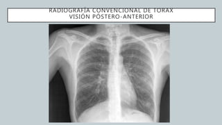 RADIOGRAFÍA CONVENCIONAL DE TORAX
VISIÓN PÓSTERO-ANTERIOR
 