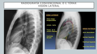 RADIOGRAFÍA CONVENCIONAL D E TÓRAX
VISIÓN LATERAL
1
 