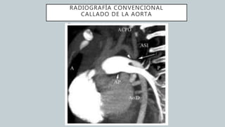 RADIOGRAFÍA CONVENCIONAL
CALLADO DE LA AORTA
 