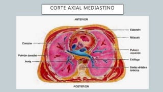 CORTE AXIAL MEDIASTINO
 