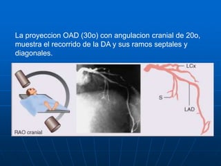 La proyeccion anteroposterior con angulacion caudal de 20o muestra el segmento distal del TCI y segmentos proximales de la...