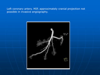 Left Coronary Artery; MIP, RAO 30°, cranial angulation 30° <br />