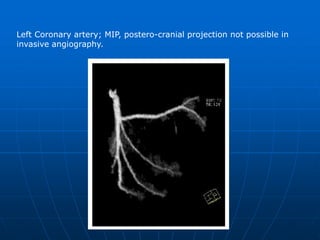 Left Coronary Artery; MIP, LAO 30°, cranial angulation 30° <br />