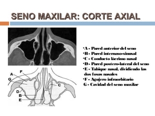 SENO MAXILAR: CORTE AXIAL


             •A - Pared anterior del seno
             •B - Pared internaso-sinusal
             •C - Conducto lácrimo nasal
             •D - Pared postero-lateral del seno
             •E - Tabique nasal, dividiendo las
              dos fosas nasales
             •F - Agujero infraorbitario
             G - Cavidad del seno maxilar
 