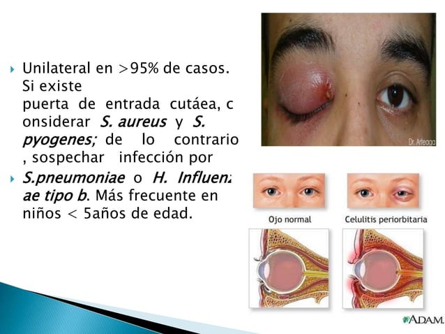 Anatomía de la orbita, celulitis preseptal, celulitis orbitaria y
