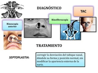 DIAGNÓSTICO
Rinoscopia
anterior
TAC
Rinofibroscopia
TRATAMIENTO
SEPTOPLASTIA:
corregir la desviación del tabique nasal,
dándole su forma y posición normal, sin
modificar la apariencia externa de la
nariz.
 