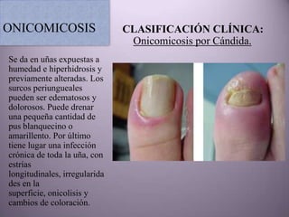 ONICOMICOSIS                   CLASIFICACIÓN CLÍNICA:
                                Onicomicosis por Cándida.
Se da en uñas expuestas a
humedad e hiperhidrosis y
previamente alteradas. Los
surcos periungueales
pueden ser edematosos y
dolorosos. Puede drenar
una pequeña cantidad de
pus blanquecino o
amarillento. Por último
tiene lugar una infección
crónica de toda la uña, con
estrías
longitudinales, irregularida
des en la
superficie, onicolisis y
cambios de coloración.
 