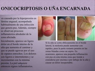 ONICOCRIPTOSIS O UÑA ENCARNADA
 es causada por la hiperpresión en
lámina ungueal, acompañada
habitualmente de una infección
que genera pus. Además, siempre
se observan procesos
inflamatorios alrededor de la
zona afectada.
Inicialmente, aparece un ligero
                                     Si la uña se corta oblicuamente en el borde
dolor en el borde interno de la      lateral, la molestia puede aumentar con
uña que aumenta al caminar y         rapidez, pues la parte restante penetra en las
que se puede agravar por el uso      zonas blandas como un arpón. En
de zapatos estrechos. Los dolores    ocasiones, aparece una pequeña inflamación
son ligeros e intermitentes y se     con pus en esta misma zona que tiende a
incrementan con la mínima            extenderse por encima o por debajo de la uña y
presión. La piel adquiere            causar un dolor insoportable.
entonces signos inflamatorios.
 