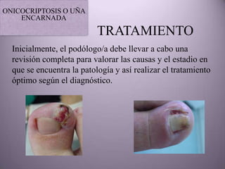 ONICOCRIPTOSIS O UÑA
    ENCARNADA

                           TRATAMIENTO
  Inicialmente, el podólogo/a debe llevar a cabo una
  revisión completa para valorar las causas y el estadio en
  que se encuentra la patología y así realizar el tratamiento
  óptimo según el diagnóstico.
 