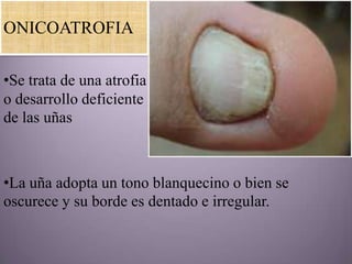 ONICOATROFIA

•Se trata de una atrofia
o desarrollo deficiente
de las uñas



•La uña adopta un tono blanquecino o bien se
oscurece y su borde es dentado e irregular.
 