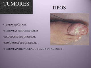 TUMORES
                                TIPOS


•TUMOR GLÓMICO.

•FIBROMAS PERIUNGUEALES

•EXOSTOSIS SUBUNGUEAL

•CONDROMA SUBUNGUEAL

•FIBROMA PERIUNGUEAL O TUMOR DE KOENEN:
 