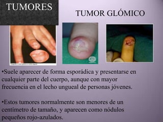 TUMORES
                            TUMOR GLÓMICO




•Suele aparecer de forma esporádica y presentarse en
cualquier parte del cuerpo, aunque con mayor
frecuencia en el lecho ungueal de personas jóvenes.

•Estos tumores normalmente son menores de un
centímetro de tamaño, y aparecen como nódulos
pequeños rojo-azulados.
 