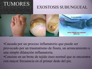 TUMORES
                       EXOSTOSIS SUBUNGUEAL




•Causada por un proceso inflamatorio que puede ser
provocado por un traumatismo de fisura, un arrancamiento o
una simple dilatación inflamatoria.
•Consiste en un brote de tejido óseo normal que se encuentra
con mayor frecuencia en el primer dedo del pie.
 
