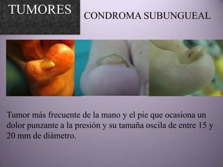 TUMORES               CONDROMA SUBUNGUEAL




Tumor más frecuente de la mano y el pie que ocasiona un
dolor punzante a la presión y su tamaña oscila de entre 15 y
20 mm de diámetro.
 