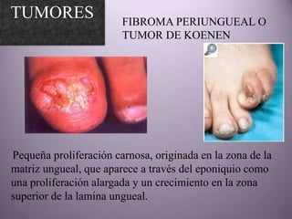 TUMORES                 FIBROMA PERIUNGUEAL O
                        TUMOR DE KOENEN




Pequeña proliferación carnosa, originada en la zona de la
matriz ungueal, que aparece a través del eponiquio como
una proliferación alargada y un crecimiento en la zona
superior de la lamina ungueal.
 