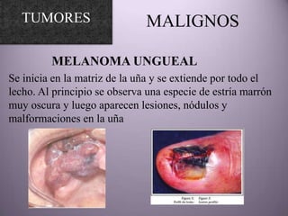 TUMORES                     MALIGNOS

         MELANOMA UNGUEAL
Se inicia en la matriz de la uña y se extiende por todo el
lecho. Al principio se observa una especie de estría marrón
muy oscura y luego aparecen lesiones, nódulos y
malformaciones en la uña
 