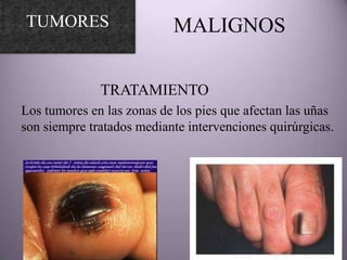 TUMORES                    MALIGNOS

              TRATAMIENTO
Los tumores en las zonas de los pies que afectan las uñas
son siempre tratados mediante intervenciones quirúrgicas.
 