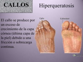 CALLOS                   Hiperqueratosis

El callo se produce por
un exceso de
crecimiento de la capa
córnea (última capa de
la piel) debido a una
fricción o sobrecarga
continua.
 