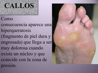 CALLOS
Como
consecuencia aparece una
hiperqueratosis
(fragmento de piel dura y
engrosada) que llega a ser
muy dolorosa cuando
existe un núcleo y que
coincide con la zona de
presión.
 