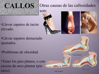 CALLOS                   Otras causas de las callosidades
                           son:


•Llevar zapatos de tacón
elevado.

•Llevar zapatos demasiado
ajustados.

•Problemas de obesidad.

•Tener los pies planos, o con
exceso de arco plantar (pie
cavo).
 
