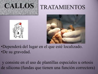 CALLOS TRATAMIENTOS




•Dependerá del lugar en el que esté localizado.
•De su gravedad.

y consiste en el uso de plantillas especiales u ortosis
de silicona (fundas que tienen una función correctora)
 