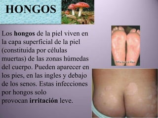 HONGOS
Los hongos de la piel viven en
la capa superficial de la piel
(constituida por células
muertas) de las zonas húmedas
del cuerpo. Pueden aparecer en
los pies, en las ingles y debajo
de los senos. Estas infecciones
por hongos solo
provocan irritación leve.
 