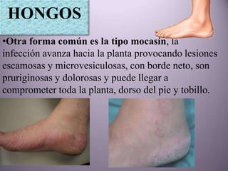HONGOS
•Otra forma común es la tipo mocasín, la
infección avanza hacia la planta provocando lesiones
escamosas y microvesiculosas, con borde neto, son
pruriginosas y dolorosas y puede llegar a
comprometer toda la planta, dorso del pie y tobillo.
 