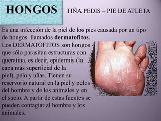 HONGOS                   TIÑA PEDIS – PIE DE ATLETA


Es una infección de la piel de los pies causada por un tipo
de hongos llamados dermatofitos.
Los DERMATOFITOS son hongos
que sólo parasitan estructuras con
queratina, es decir, epidermis (la
capa más superficial de la
piel), pelo y uñas. Tienen su
reservorio natural en la piel y pelos
del hombre y de los animales y en
el suelo. A partir de estas fuentes se
pueden contagiar al hombre y los
animales.
 