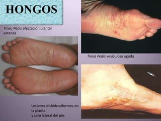 HONGOS
Tinea Pedis afectación plantar
extensa




                                                Tinea Pedis vesiculosa aguda




                 Lesiones dishidrosiformes en
                 la planta
                 y cara lateral del pie.
 