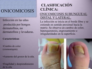 CLASIFICACIÓN
ONICOMICOSIS                     CLÍNICA:
                                 ONICOMICOSIS SUBUNGUEAL
                                 DISTAL Y LATERAL.
Infección en las uñas            La infección se inicia en el borde libre y se
 producida por hongos            extiende en sentido proximal hacia la
dermatofitos, no                 matriz. Se observa un cambio de color,
dermatofitos y levaduras.        hiperqueratosis, engrosamiento e
                                 irregularidades en la superficie.
Características

•Cambio de color
(cromoniquia).

•Aumento del grosor de la uña.

•Fragilidad y desprendimiento
de la uña
 