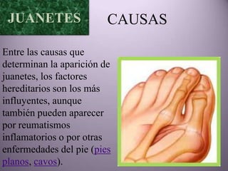 JUANETES                CAUSAS

Entre las causas que
determinan la aparición de
juanetes, los factores
hereditarios son los más
influyentes, aunque
también pueden aparecer
por reumatismos
inflamatorios o por otras
enfermedades del pie (pies
planos, cavos).
 