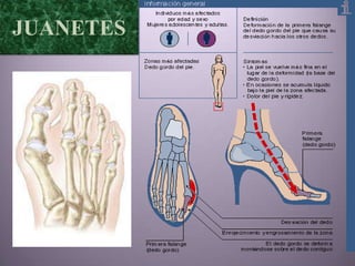 JUANETES
 