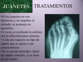 JUANETES TRATAMIENTOS
•Si los juanetes no son
dolorosos y no impiden el
calzado, se aconseja no
operarlos.
•A veces se confunde la estética
con la dificultad para calzarse.
• Cada pie requiere un tipo de
zapato que se ajuste a sus
características.
•No se puede pretender calzar
un zapato estrecho, si se tiene
un pie ancho.
 