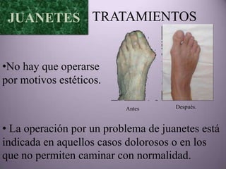 JUANETES TRATAMIENTOS


•No hay que operarse
por motivos estéticos.

                          Antes      Después.



• La operación por un problema de juanetes está
indicada en aquellos casos dolorosos o en los
que no permiten caminar con normalidad.
 