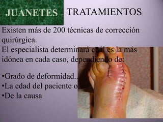 JUANETES TRATAMIENTOS
Existen más de 200 técnicas de corrección
quirúrgica.
El especialista determinará cuál es la más
idónea en cada caso, dependiendo de:

•Grado de deformidad..
•La edad del paciente o..
•De la causa
 