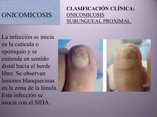 CLASIFICACIÓN CLÍNICA:
ONICOMICOSIS               ONICOMICOSIS
                           SUBUNGUEAL PROXIMAL.


La infección se inicia
en la cutícula o
eponiquio y se
extiende en sentido
distal hacia el borde
libre. Se observan
lesiones blanquecinas
en la zona de la lúnula.
Esta infección se
asocia con el SIDA.
 